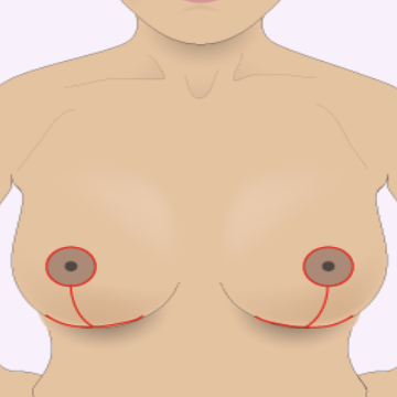 Olivier Amar Cosmetic Surgery London breast lift mastopexy scars