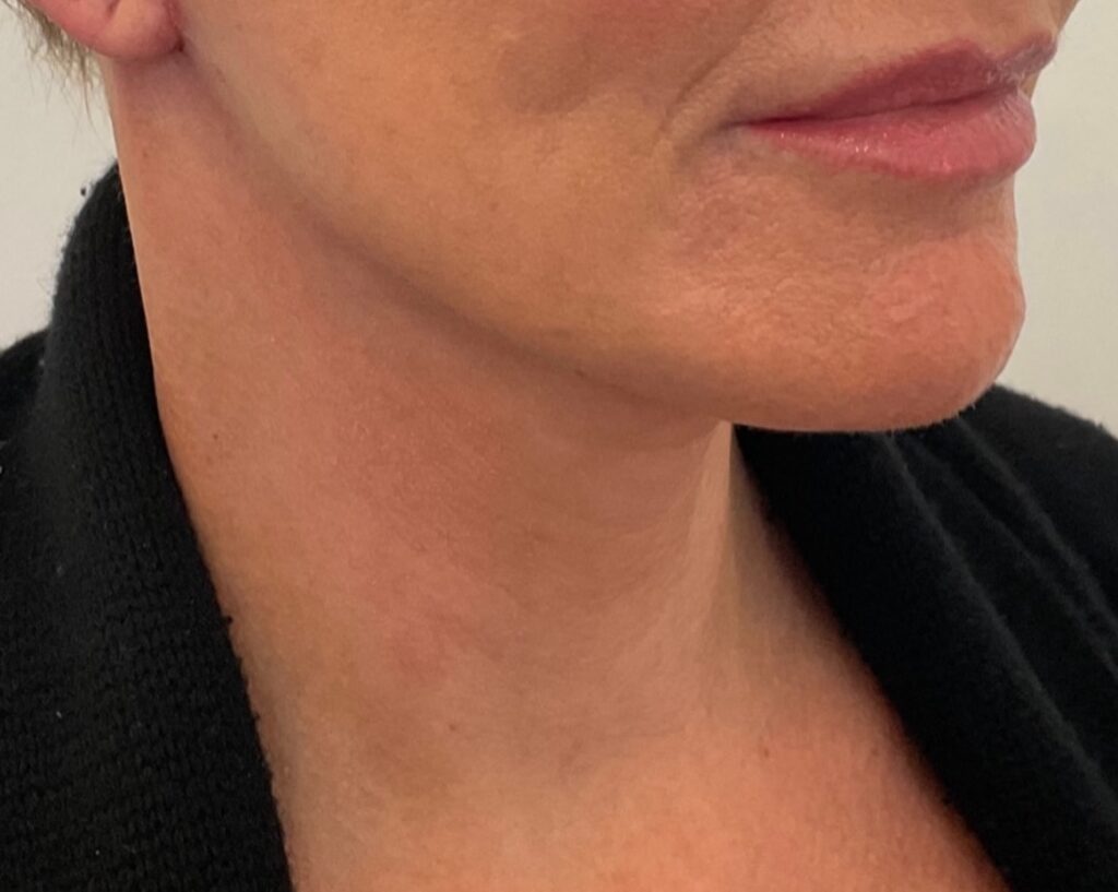 Olivier Amar Cosmetic Surgery London face and neck lift and Renuvion J Plasma skin tightening and liposuction to neck before and after
