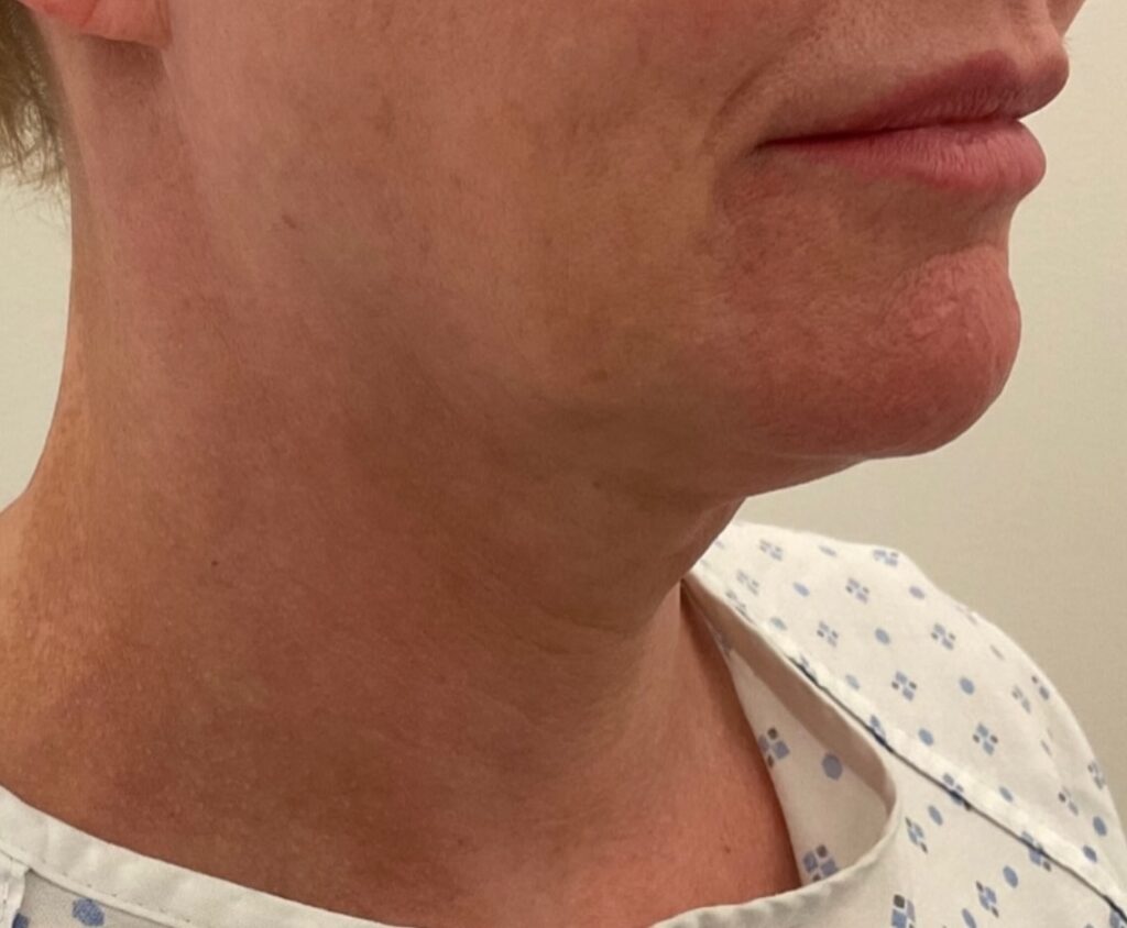 Olivier Amar Cosmetic Surgery London face and neck lift and Renuvion J Plasma skin tightening and liposuction to neck before and after