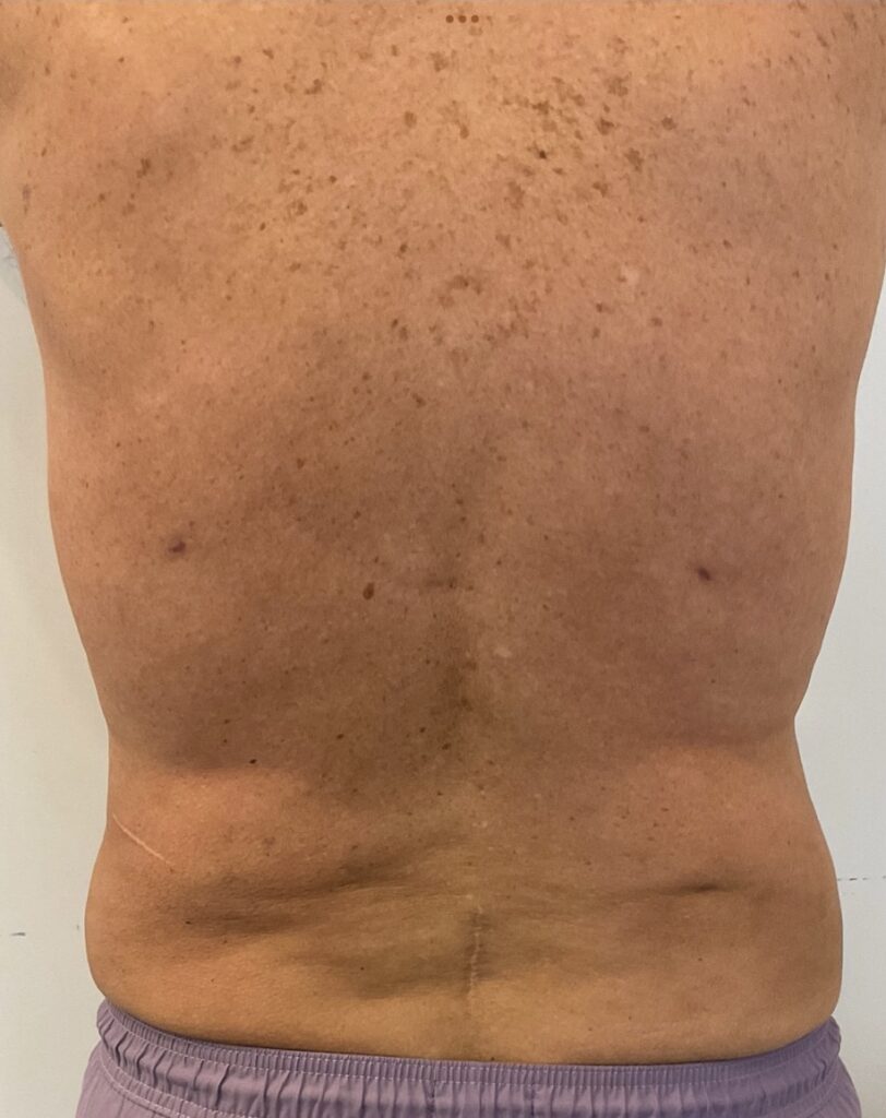 Olivier Amar Cosmetic Surgery London liposuction male body contouring and Renuvion J Plasma skin tightening before and after