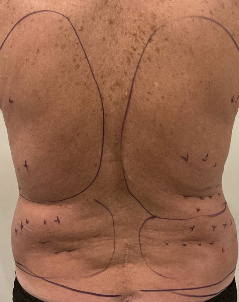 Olivier Amar Cosmetic Surgery London liposuction male body contouring and Renuvion J Plasma skin tightening before and after