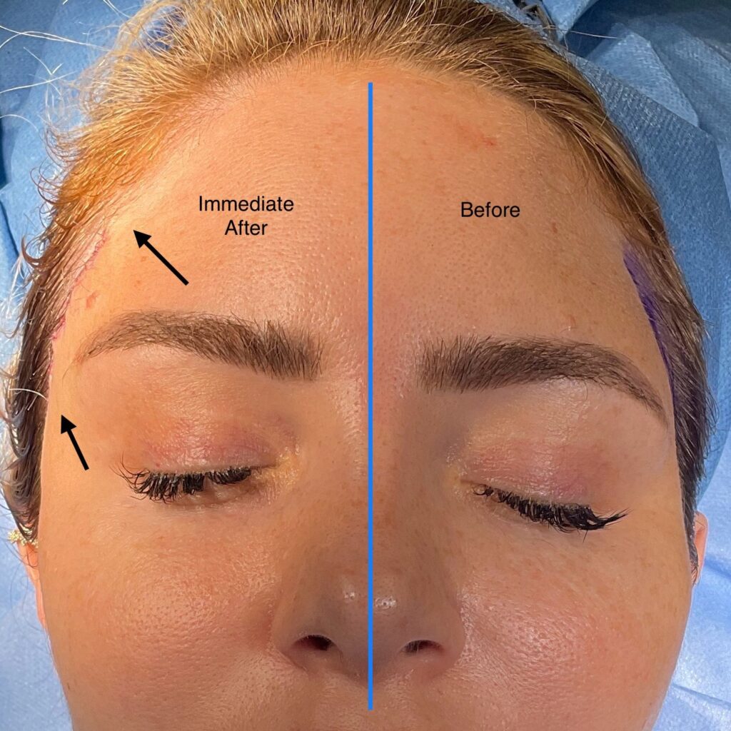 Lateral Temporal Brow Lift By Olivier Amar London Lateral Temporal Brow Lift By Olivier Amar London