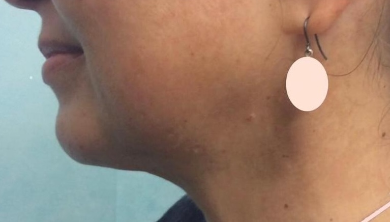 Olivier Amar Cosmetic Surgery London Chin & Neck Liposuction double chin liposuction before & after