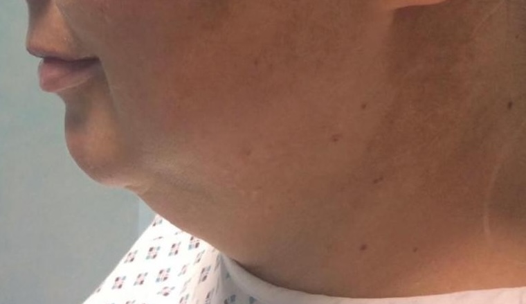 Olivier Amar Cosmetic Surgery London Chin & Neck Liposuction double chin liposuction before & after