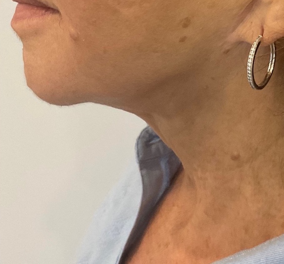 Olivier Amar Cosmetic Surgery London Renvuion J Plasma skin tightening micro liposuction to chin and neck before and after