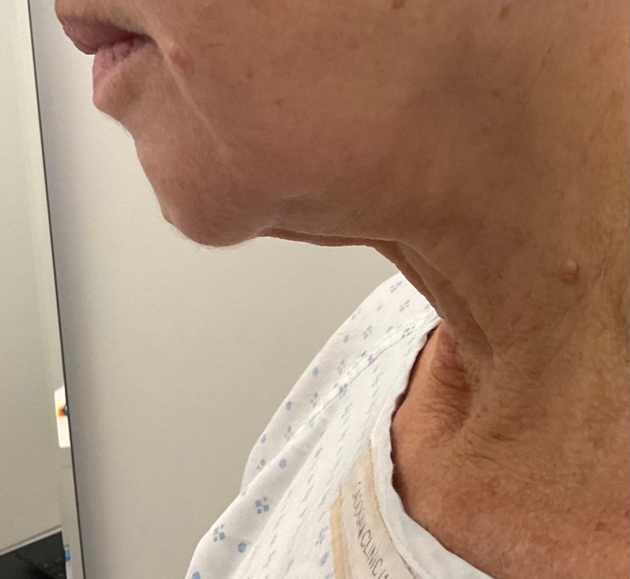 Olivier Amar Cosmetic Surgery London Renvuion J Plasma skin tightening micro liposuction to chin and neck before and after