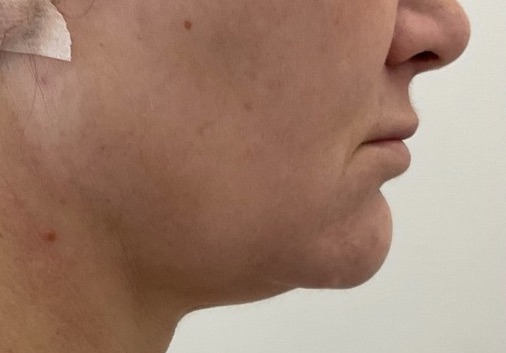 Olivier Amar Cosmetic Surgery London Renvuion J Plasma skin tightening micro liposuction to chin and neck before and after
