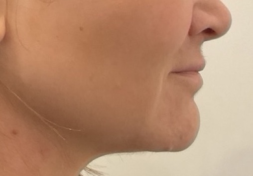 Olivier Amar Cosmetic Surgery London Renvuion J Plasma skin tightening micro liposuction to chin and neck before and after