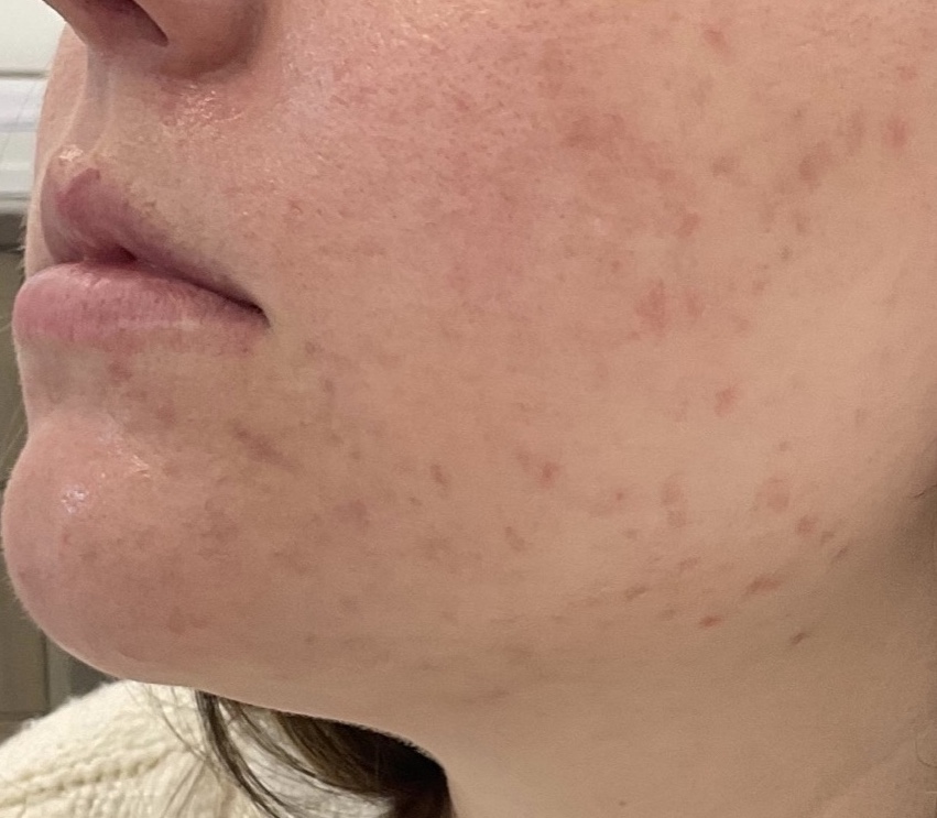 Olivier Amar Cosmetic Surgery London Aerolase Neo Skin Rejuvenation Acne before and after