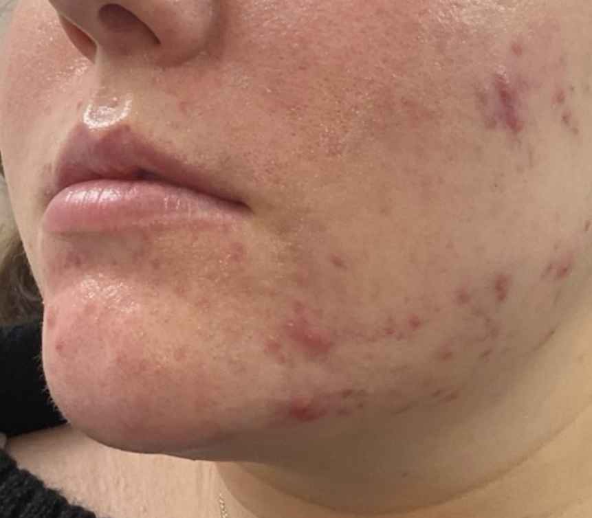 Olivier Amar Cosmetic Surgery London Aerolase Neo Skin Rejuvenation Acne before and after