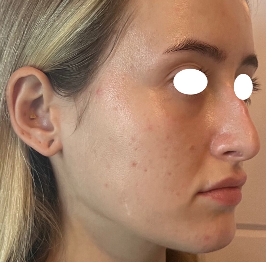Olivier Amar Cosmetic Surgery London Aerolase Neo Skin Rejuvenation Acne before and after