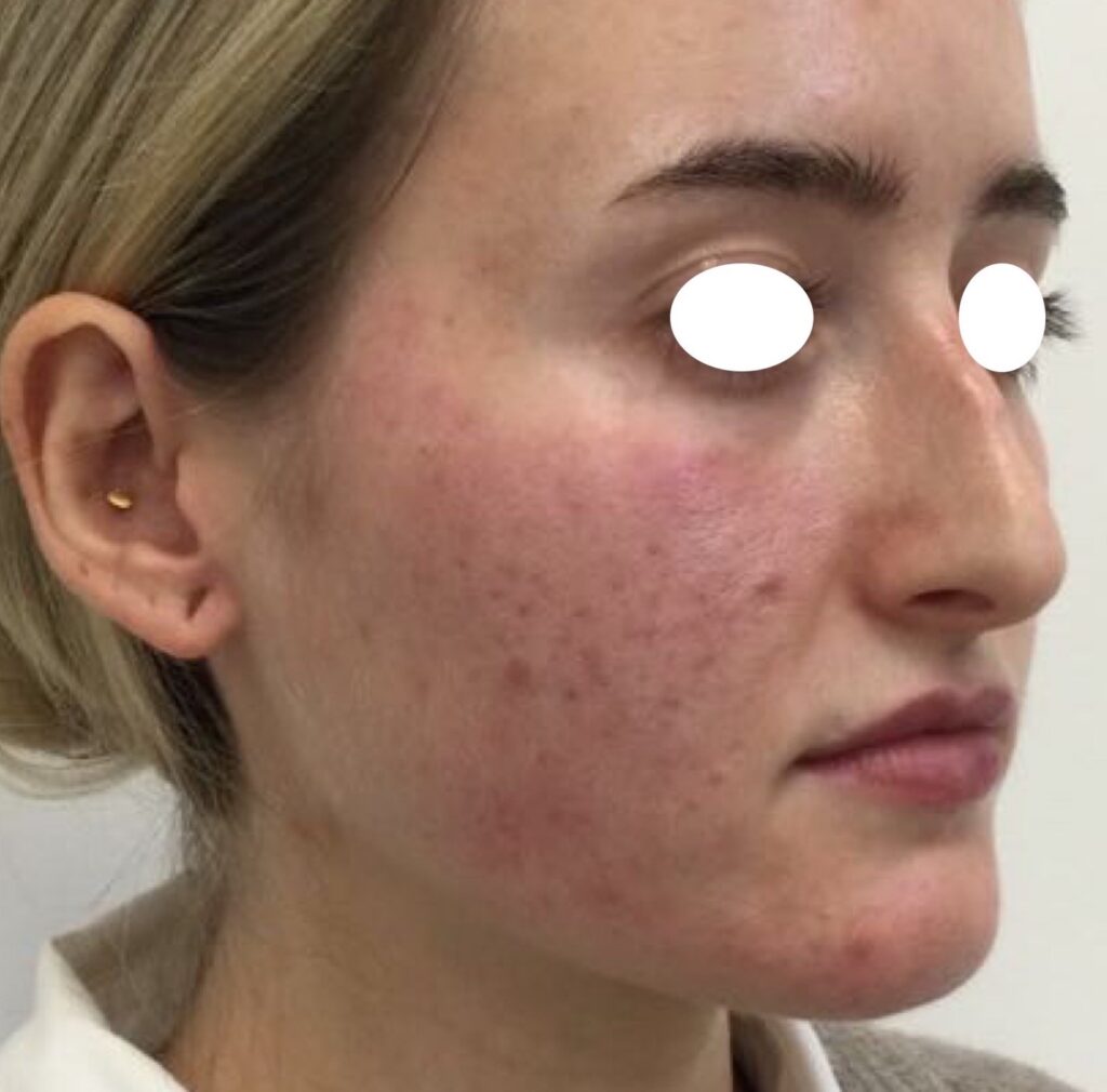 Olivier Amar Cosmetic Surgery London Aerolase Neo Skin Rejuvenation Acne before and after