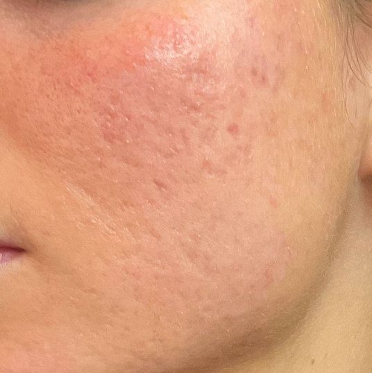 Olivier Amar Cosmetic Surgery London Aerolase Neo Skin Rejuvenation Acne before and after