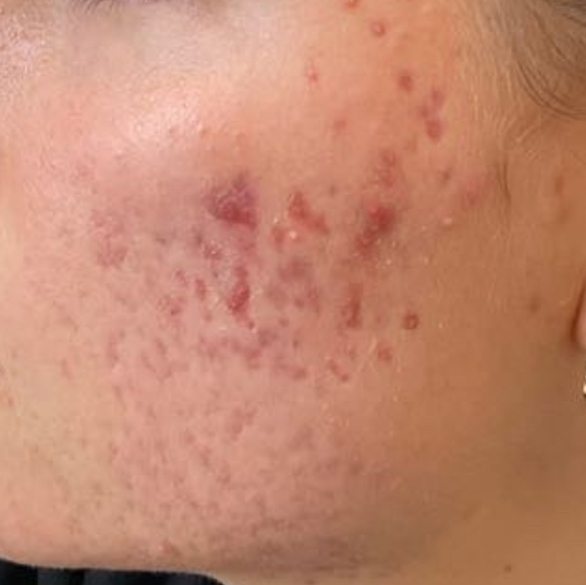 Olivier Amar Cosmetic Surgery London Aerolase Neo Skin Rejuvenation Acne before and after