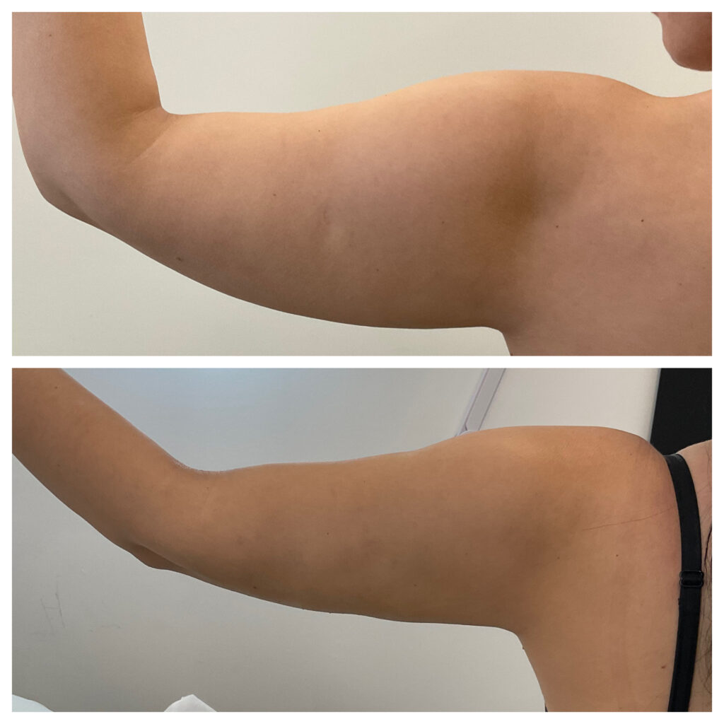 Renuvion Skin Tightening By Olivier Amar London Renuvion Skin Tightening By Olivier Amar London
