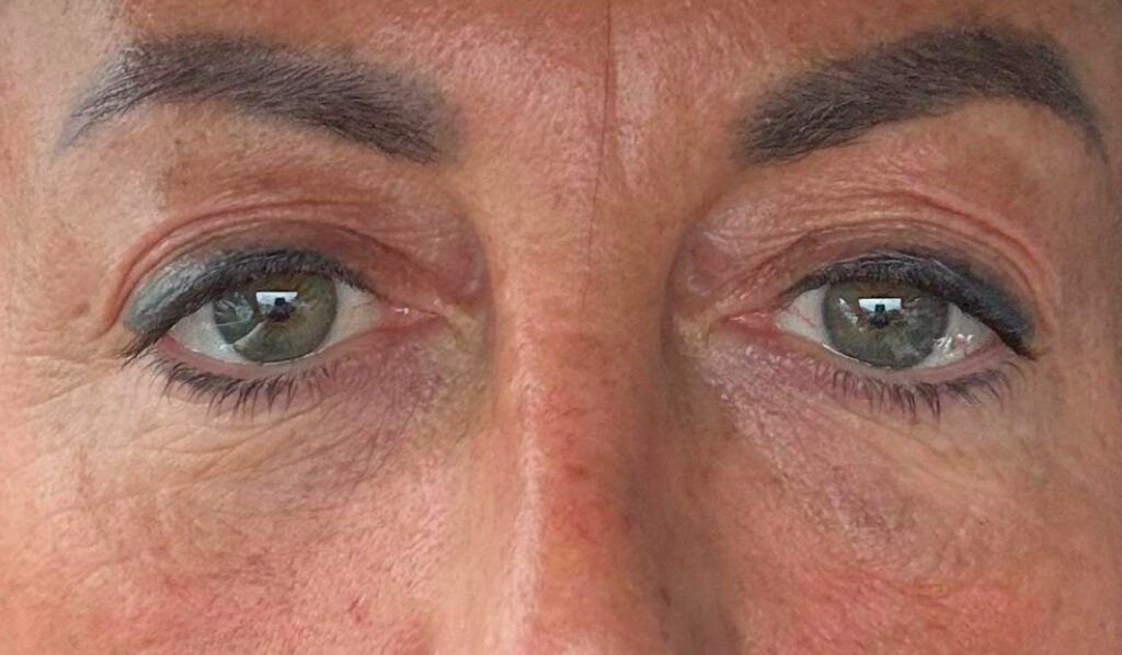 Olivier Amar Cosmetic Surgery London polynucleotides & dermal filler treatment, skin booster rejuvenation