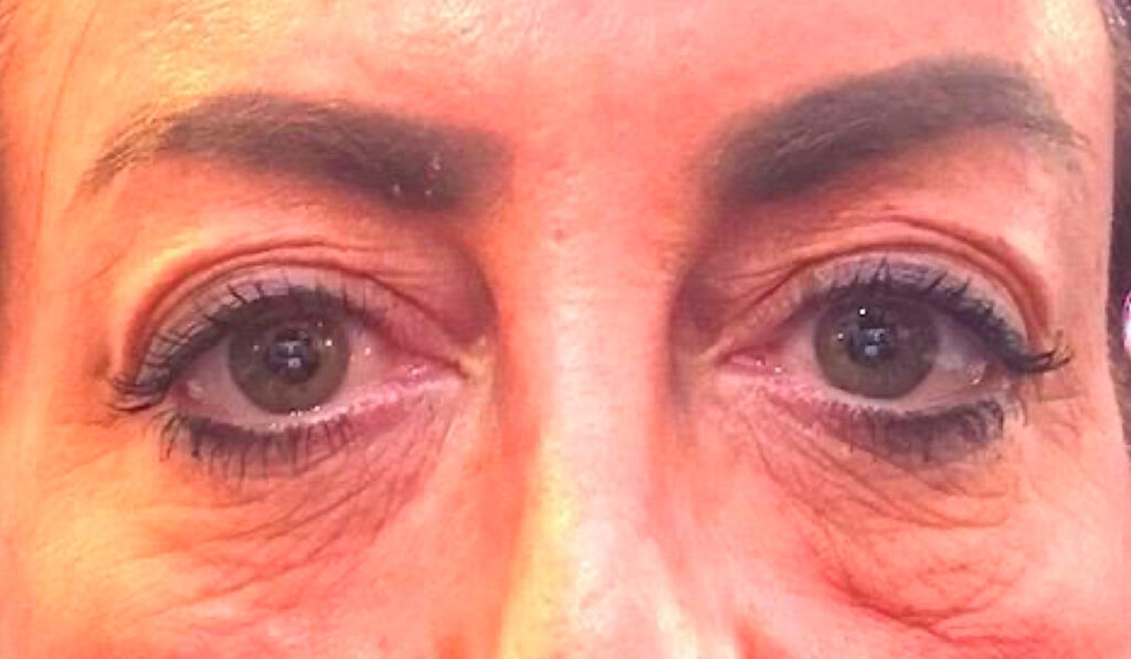 Olivier Amar Cosmetic Surgery London polynucleotides & dermal filler treatment, skin booster rejuvenation