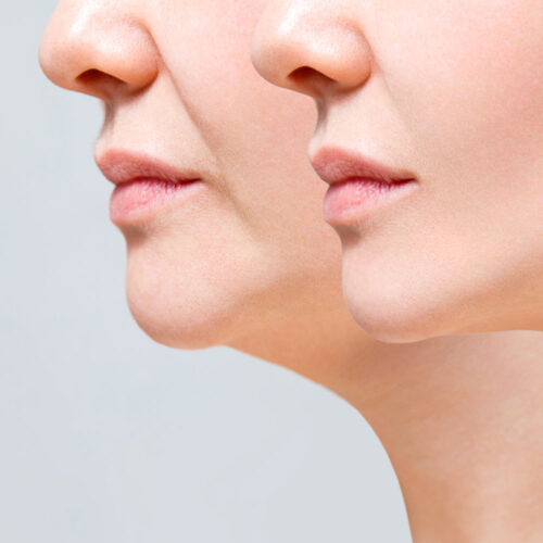 Olivier Amar Cosmetic Surgery London chin and neck liposuction treatment