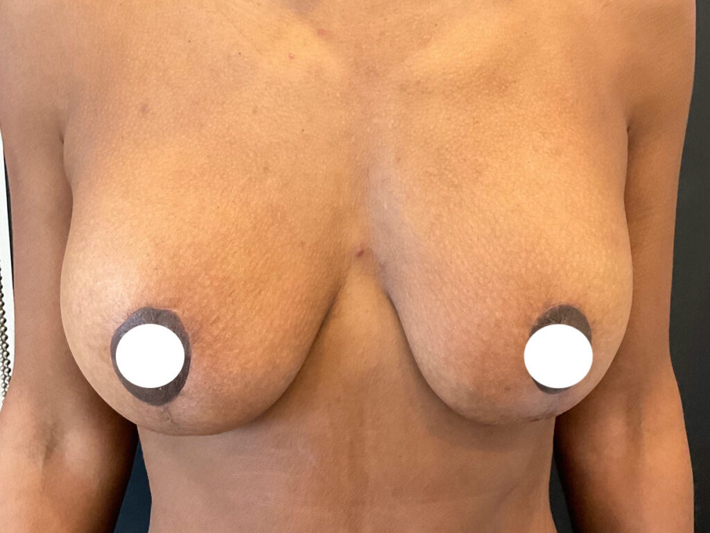 Olivier Amar Cosmetic Surgery London Breast lift with implants mastopexy augmentation before and after