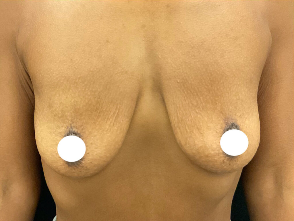 Olivier Amar Cosmetic Surgery London Breast lift with implants mastopexy augmentation before and after