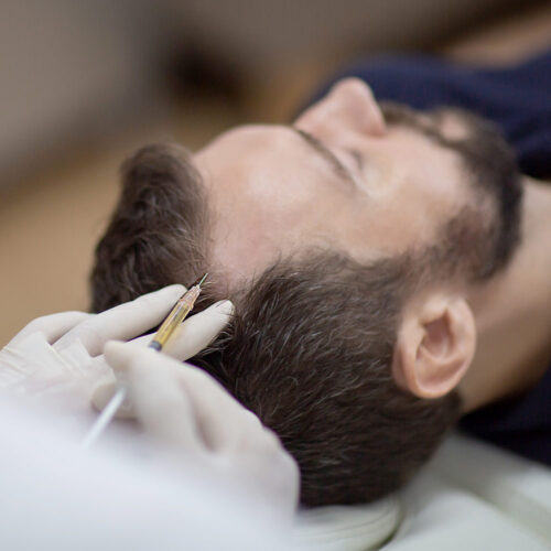 Olivier Amar Cosmetic Surgery London PRP hair restoration treatment autologous hair restoration