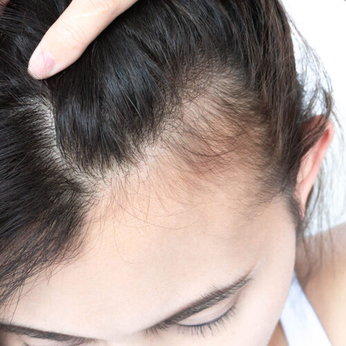 Olivier Amar Cosmetic Surgery London nano fat transfer to scalp autologous stem cell hair transplant