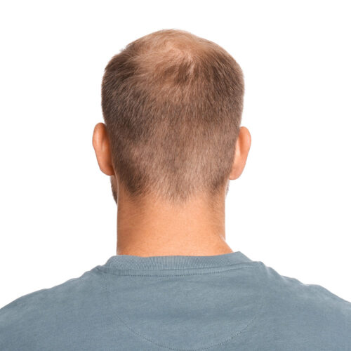 Olivier Amar Cosmetic Surgery London prp and nano fat transfer to scalp autologous hair restoration treatments